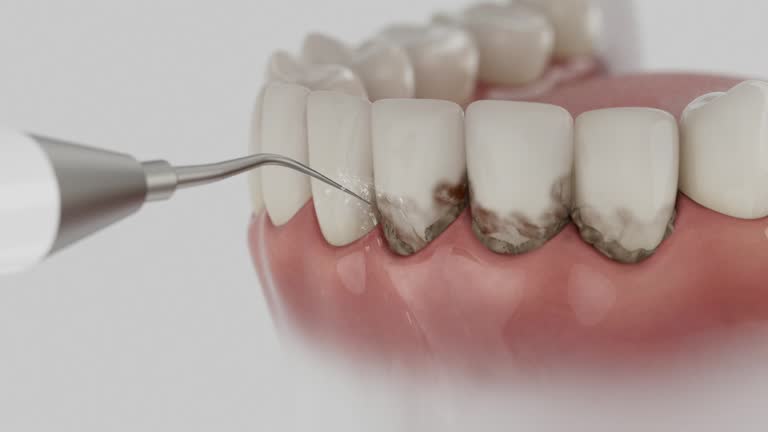 Trusted Wisdom Tooth Removal service in Deerfield, IL - Dentist Open Now